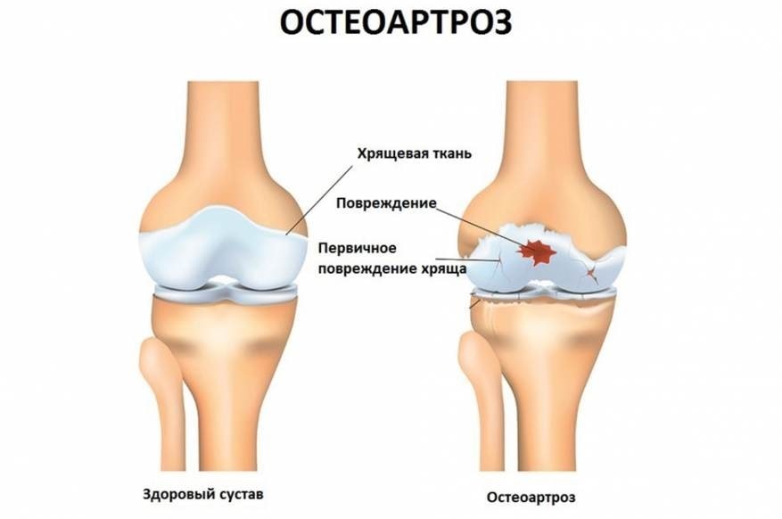 лечение остеоартроза казань